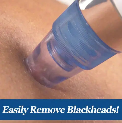 Electric Blackhead Remover Facial Cleansing Device Frezze_Luxe