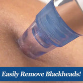 Electric Blackhead Remover Facial Cleansing Device Frezze_Luxe
