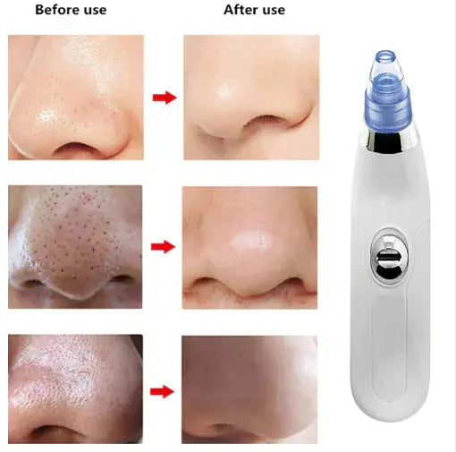Electric Blackhead Remover Facial Cleansing Device Frezze_Luxe