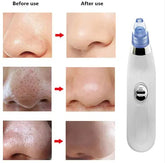 Electric Blackhead Remover Facial Cleansing Device Frezze_Luxe