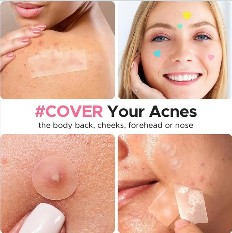 LitBear 3 IN 1 Acne Patch for Face 7 Sizes 368 Patches Hydrocolloid Acne Patches for Chin Forehead Nose 16 XL Pimple Patches Large for Body Heart-Shaped Acne Cover Zit Patches Acne Dots Sticker Frezze_Luxe