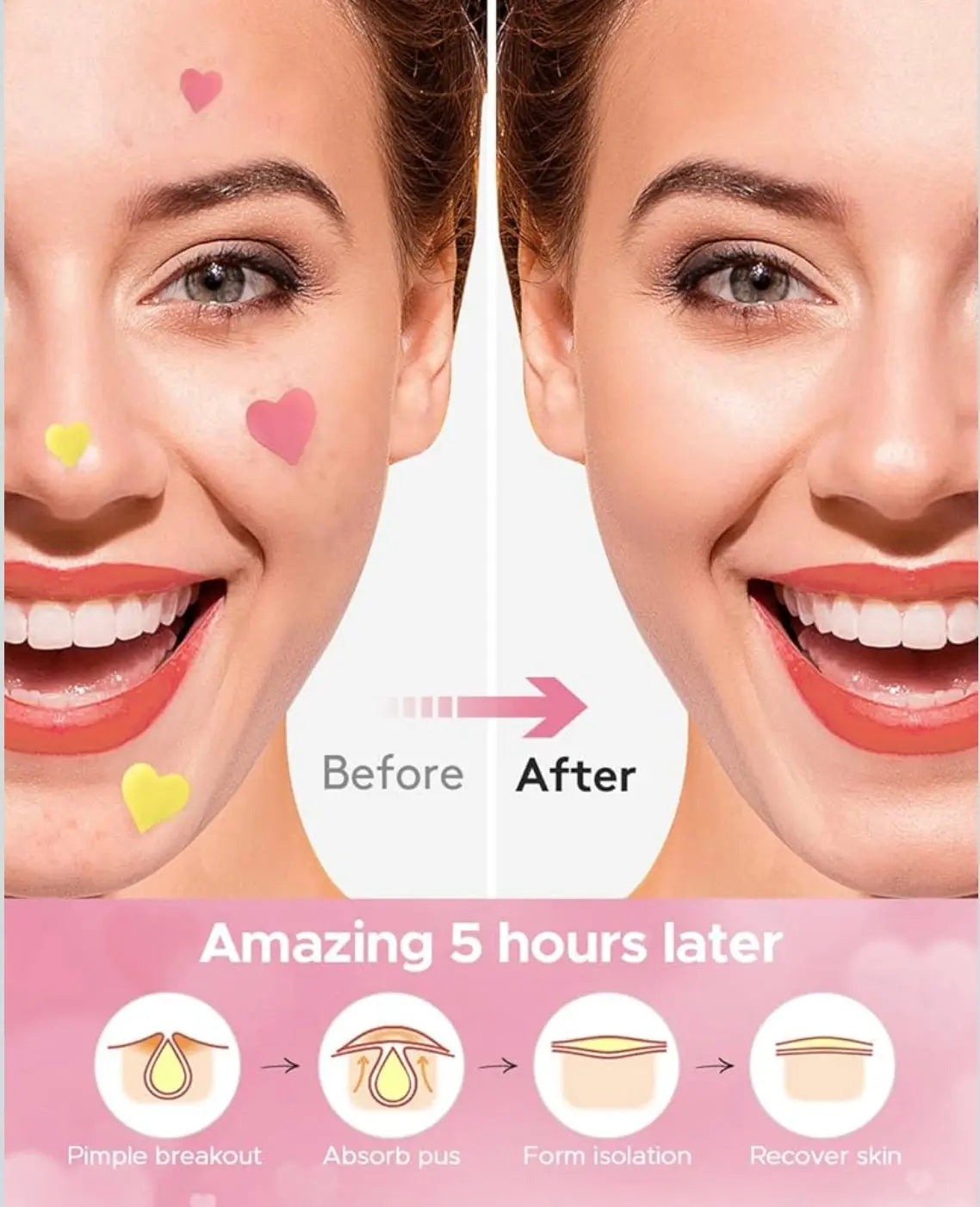 LitBear 3 IN 1 Acne Patch for Face 7 Sizes 368 Patches Hydrocolloid Acne Patches for Chin Forehead Nose 16 XL Pimple Patches Large for Body Heart-Shaped Acne Cover Zit Patches Acne Dots Sticker Frezze_Luxe